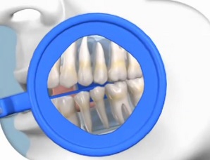 Intra Oral Positioning